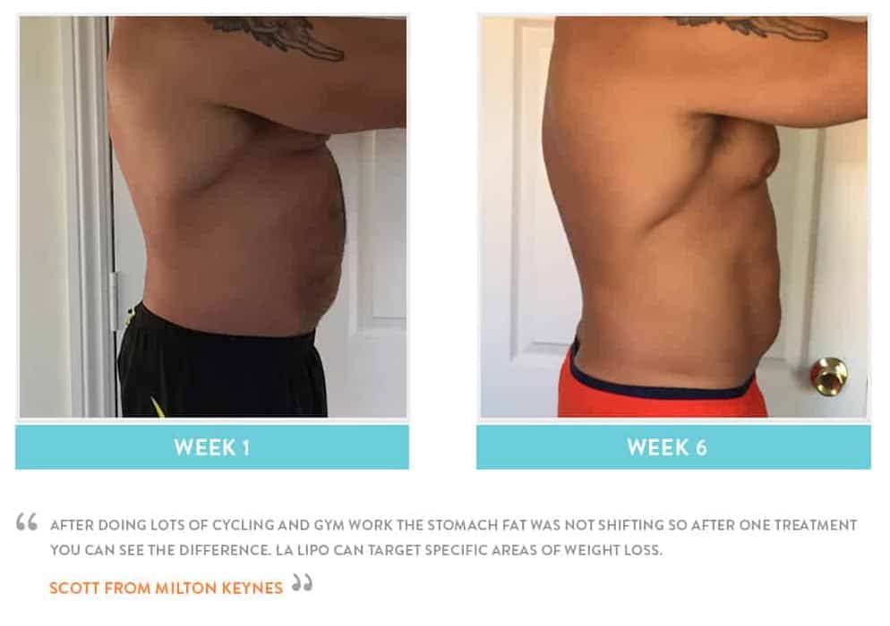 Before & After Stomach Fat Greater London (Lewisham)