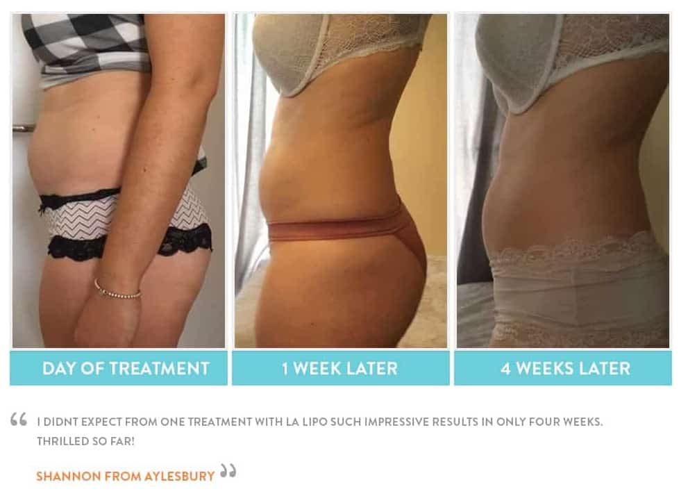 before, Cryolipolysis Greater London (Lewisham)
