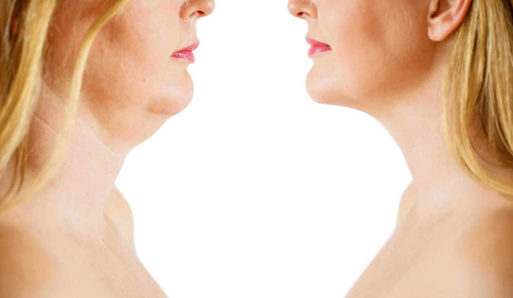 Double Chin treatment Greater London (Lewisham) before and after results