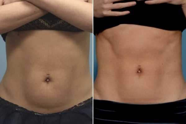 body sculpting FAQs Greater London (Lewisham)