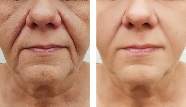 Learn more about Morpheus8 Treatment Greater London (Lewisham) today!