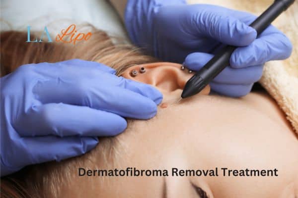 Dermatofibroma Removal Treatment Greater London (Lewisham)