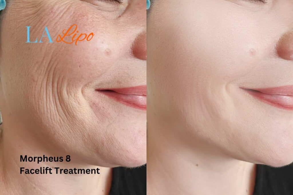 Morpheus8 Treatment Greater London (Lewisham) for flawless skin! Call us today!