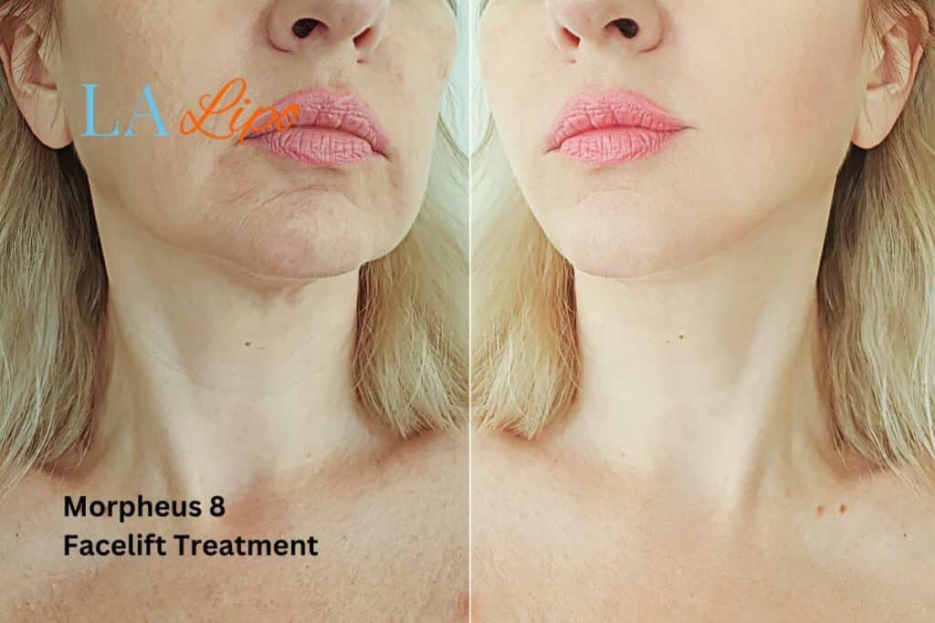 Turn back time with Morpheus8 Treatment Greater London (Lewisham)