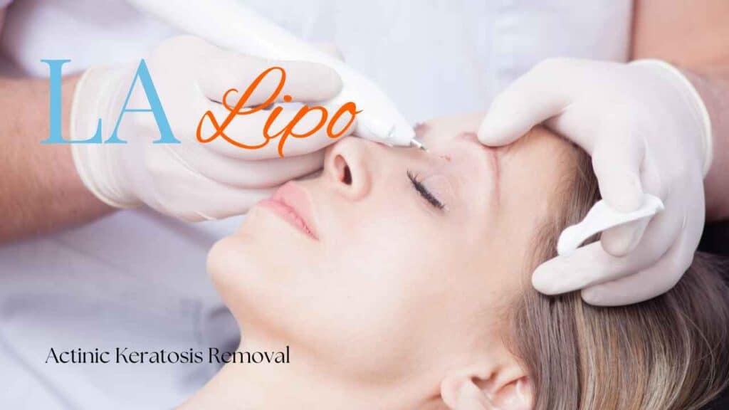 actinic keratosis removal Greater London (Lewisham)