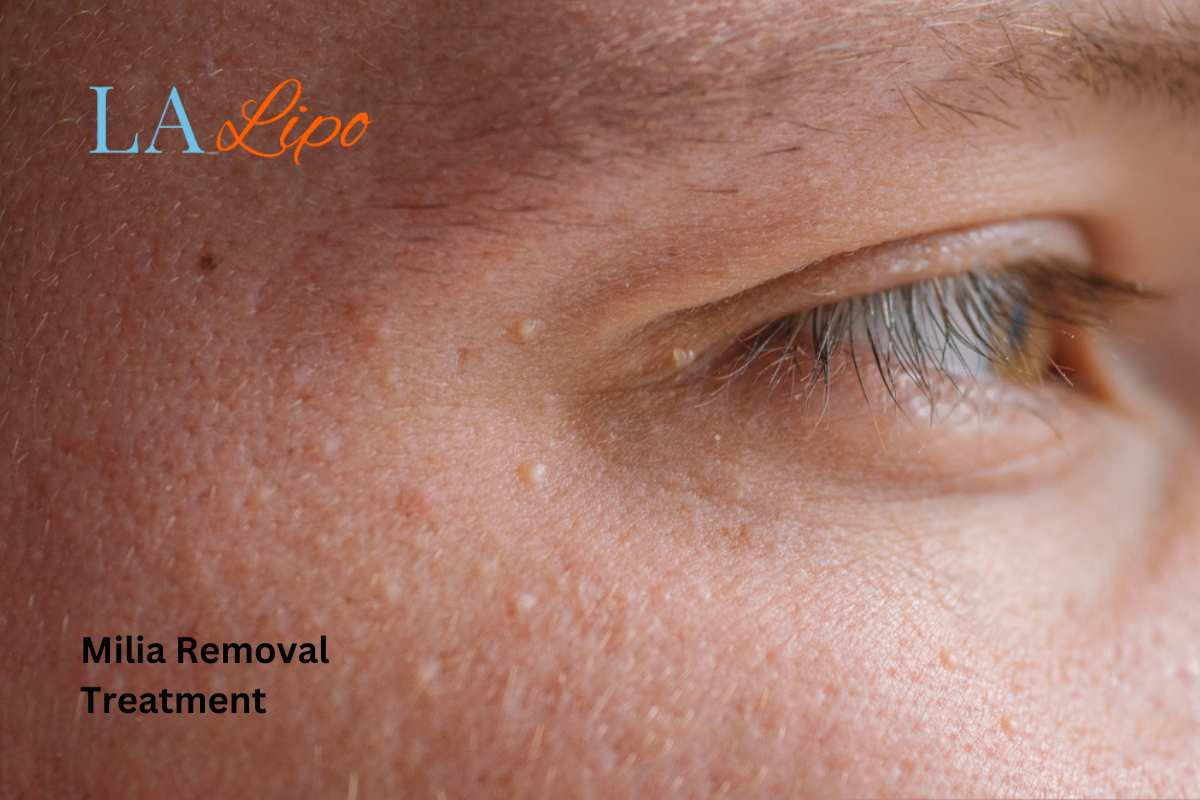 Cryopen Milia Removal: Is It the Easiest and Safest Option Greater London (Lewisham)?
