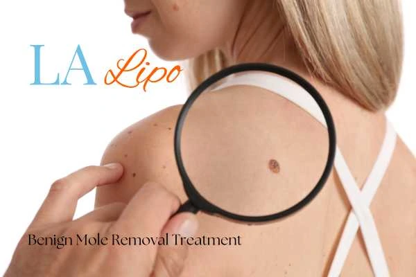 Why getting moles removed Greater London (Lewisham) can boost your confidence!