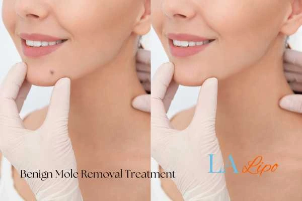 woman's before and after mole removal Greater London (Lewisham) results