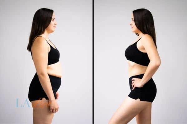 LA-EMS Body Sculpting Greater London (Lewisham) results before and after of womans results on body toning.