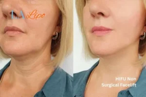 hi-fu for wrinkles Greater London (Lewisham) before and after results