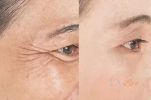 Before and after results of woman - HI-fu wrinkles reduction treatment Greater London (Lewisham)