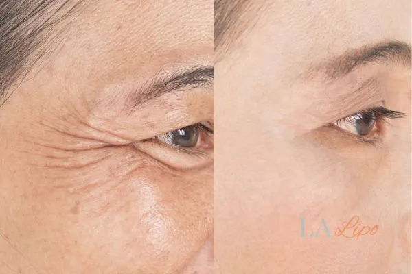 Before and after results of woman - HI-fu wrinkles reduction treatment Greater London (Lewisham)