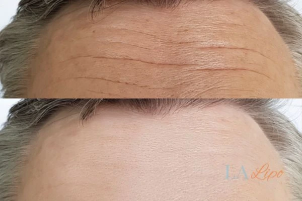 results of HIFU Greater London (Lewisham) on mans forehead to help reduce lines and wrinkles