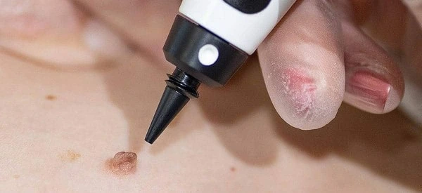 skin tag removal using cryopen Greater London (Lewisham)