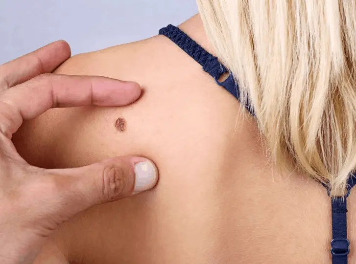 woman having mole removal Greater London (Lewisham) consultation before treatment.