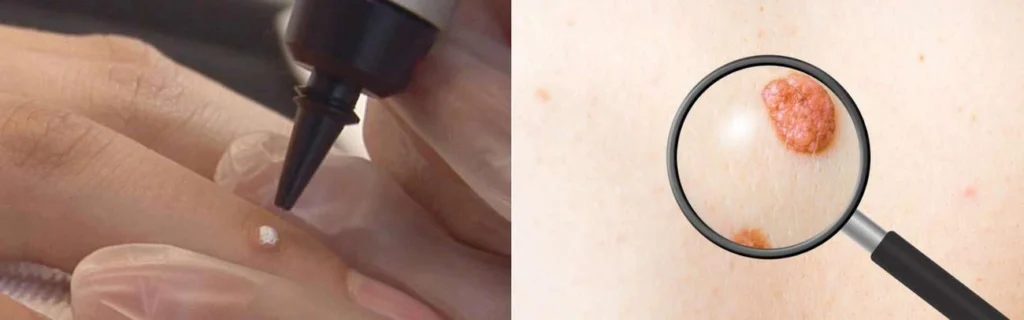 Person getting moles removed with cryopen Greater London (Lewisham)