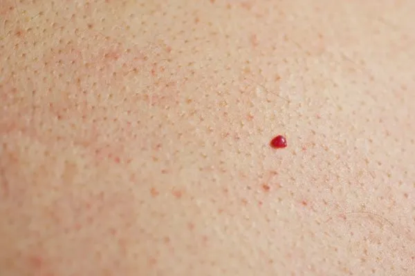 close up of a cherry angioma Greater London (Lewisham)
