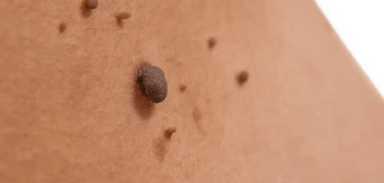 image of a skin tag Greater London (Lewisham)