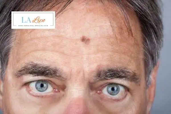 Solar Lentigo Removal Greater London (Lewisham) image of man with mark on his forehead