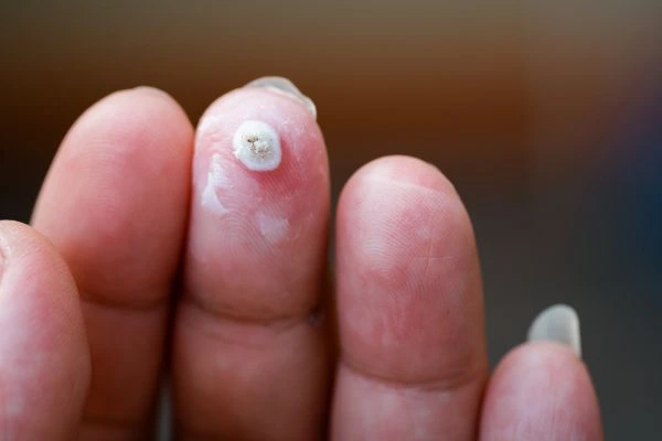 wart on person finger - cryotherapy to treat from LA LIPO Greater London (Lewisham)