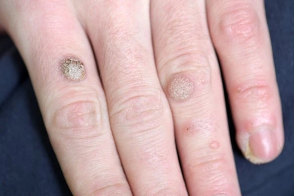 photo of warts on person hand - see wart removal Greater London (Lewisham) from LA LIPO