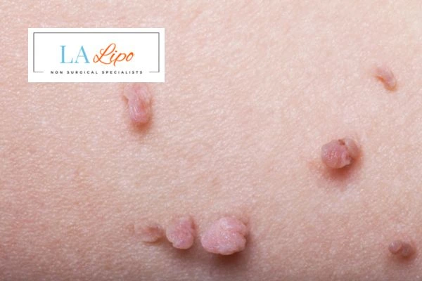 Does cryopen skin tag removal Greater London (Lewisham) hurt? Find out now call our team today!