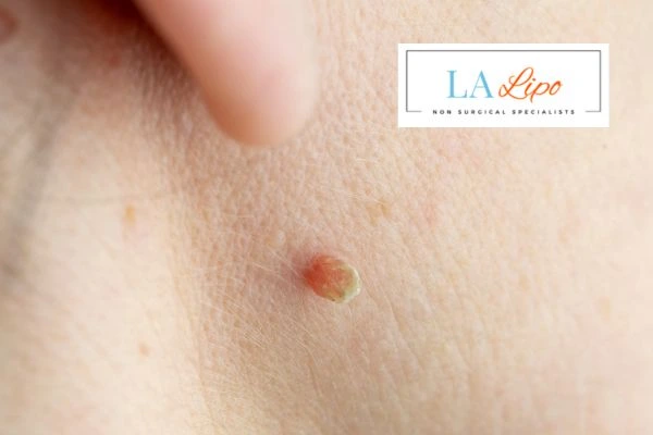 Book skin tag removal Greater London (Lewisham) today speak to our team now!