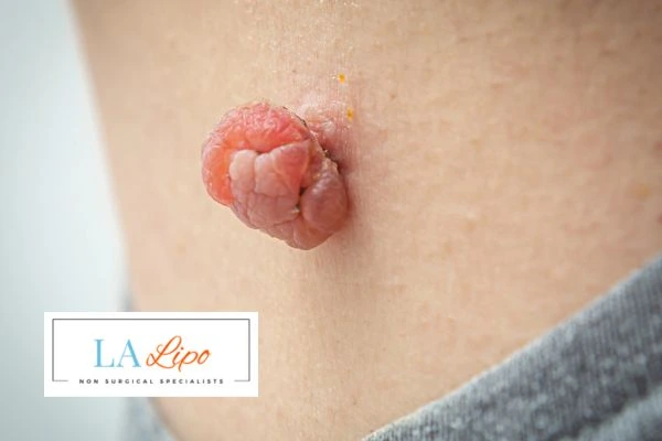 Interested in skin tag removal Greater London (Lewisham)? Concerned about the pain? Find out more today!