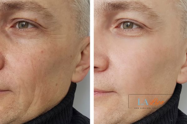 See the amazing results of Morpheus8 Treatment Greater London (Lewisham)!