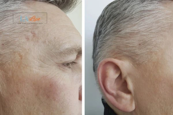 Mens Before & After Morpheus 8 Results Greater London (Lewisham)
