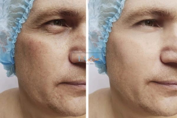 Before and after Morpheus 8 Results Greater London (Lewisham)