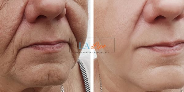 Older lady deeper wrinkle reduction - LA LIPO Morpheus 8 Results Greater London (Lewisham)
