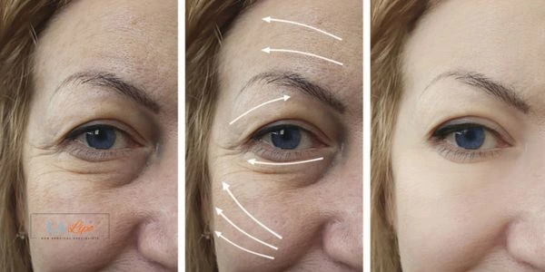 Amazing eye lift Morpheus 8 results Greater London (Lewisham)