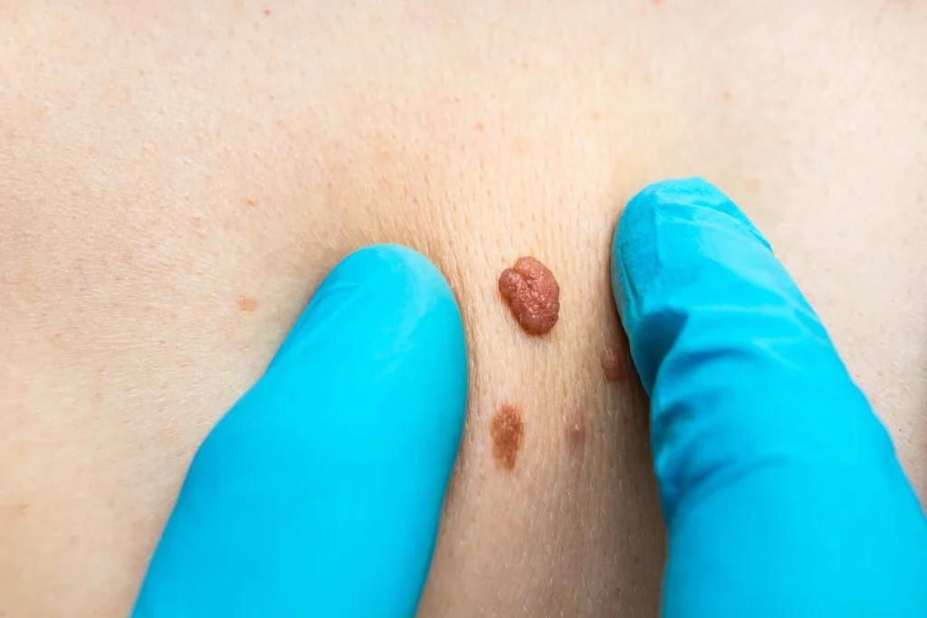 LA LIPO Cryopen Lesion Removal Prices Greater London (Lewisham)