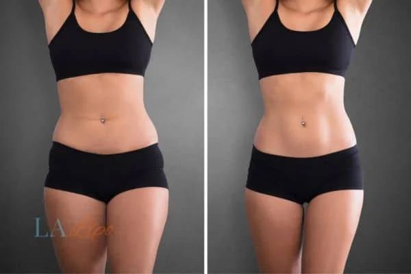 before and after results of non-surgical treatment to help a woman's body image and mental health Greater London (Lewisham)