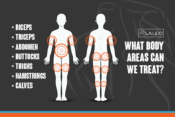 Diagram to show areas you can have LA-EMS Body Sculpting Treatment Greater London (Lewisham)