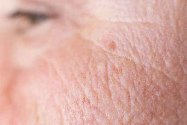 close up picture of a woman's face showing an age spot Greater London (Lewisham)