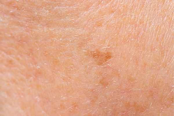 close up picture of age spots Greater London (Lewisham)