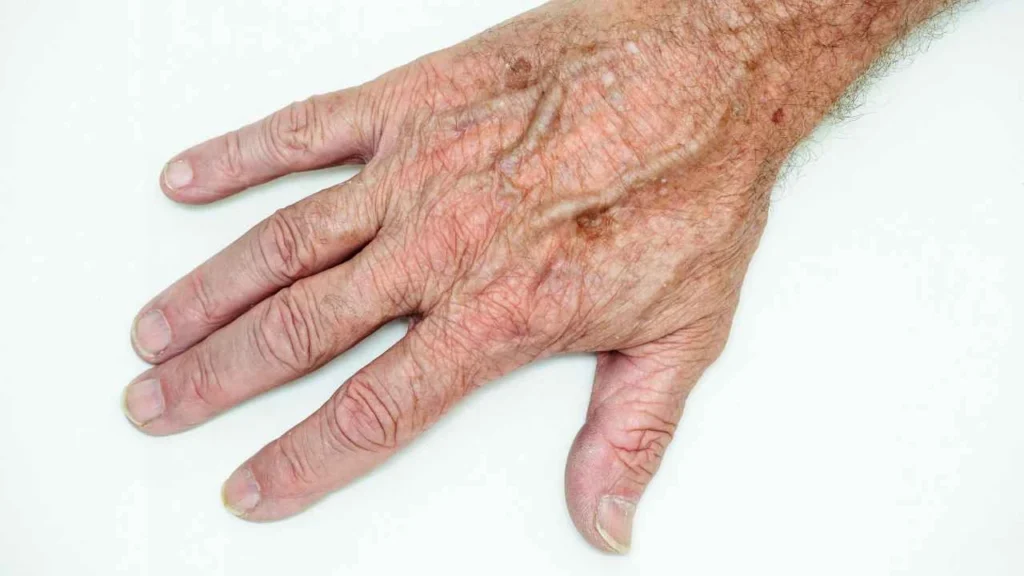 Male hand showing age spot Greater London (Lewisham)
