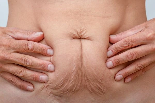 Image of a woman's stomach with loose skin - example of skin tightening Greater London (Lewisham) options